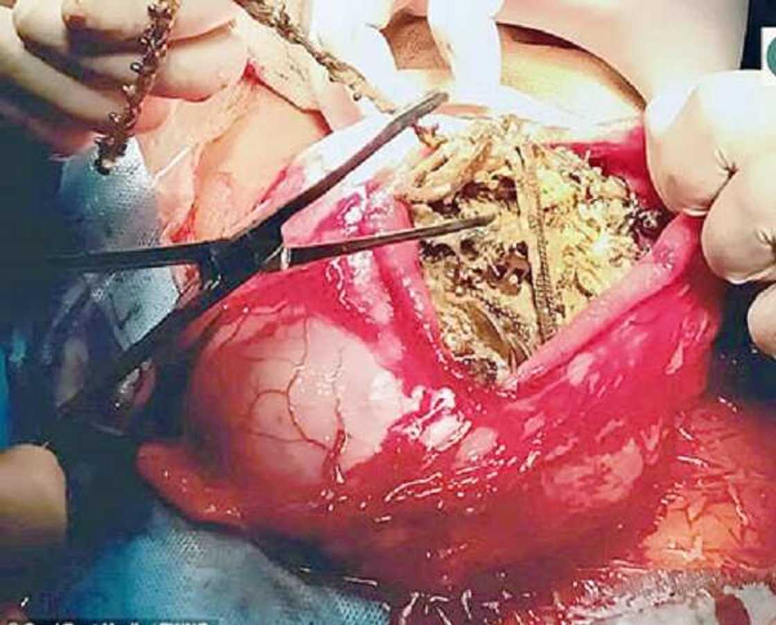 Likitoci sun ciro sarka 69, dan kunne 80 da kwabbai 46 a cikin wata mata Likitoci sun ciro sarka 69, dan kunne 80 da kwabbai 46 a cikin wata mata