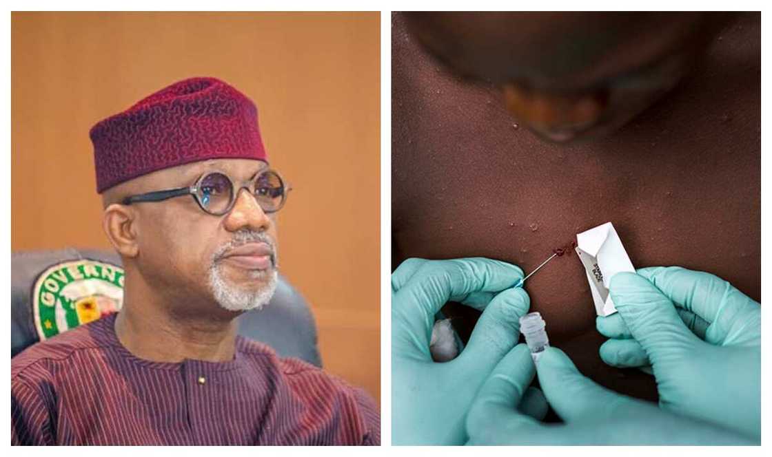 Monkeypox Monkeypox