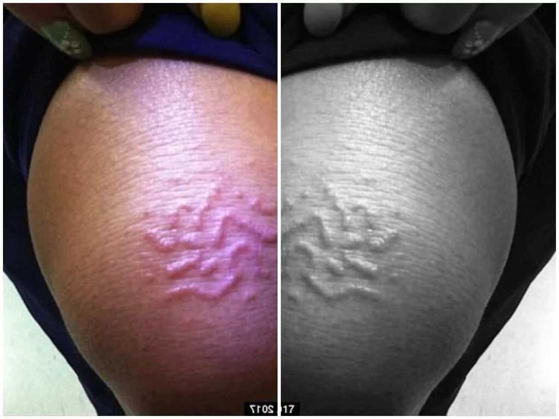 Woman, 45, discovers worm buried under her skin 2 weeks after beach vacation Woman, 45, discovers worm buried under her skin 2 weeks after beach vacation