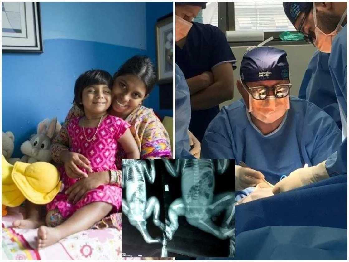 3-year-old toddler who was born with 3 legs can walk and run after surgery 3-year-old toddler who was born with 3 legs can walk and run after surgery