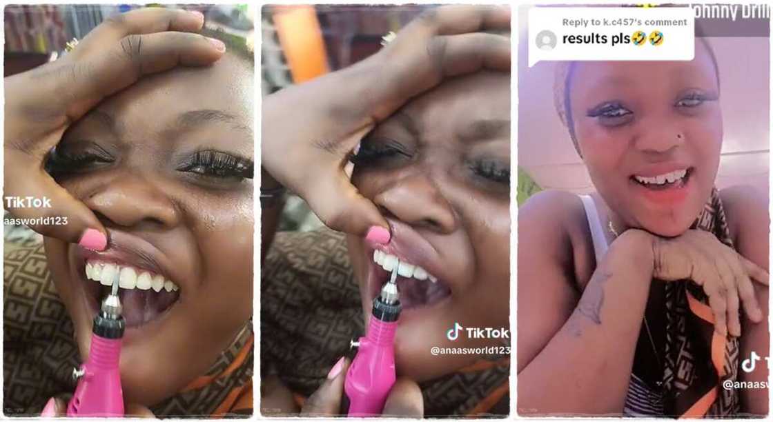 A lady gets artificial diastema popularly called open teeth. A lady gets artificial diastema popularly called open teeth.