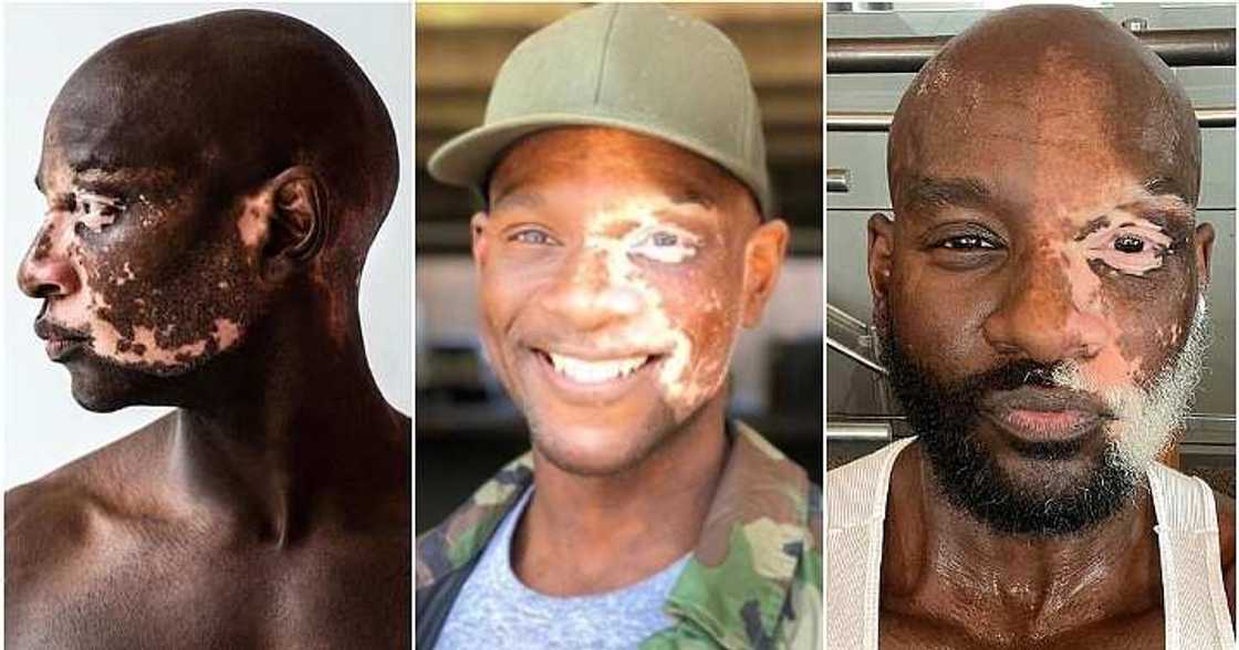 Model with vitiligo, model, bully Model with vitiligo, model, bully