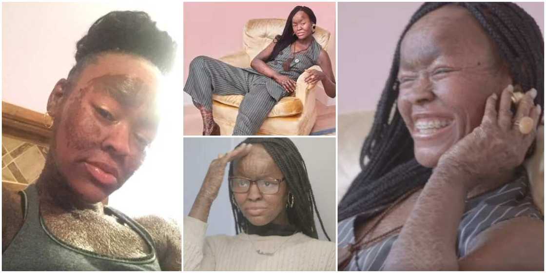 Jeyza: The 21-year-old who sheds skin every 10 days and doesn't sweat Jeyza: The 21-year-old who sheds skin every 10 days and doesn't sweat