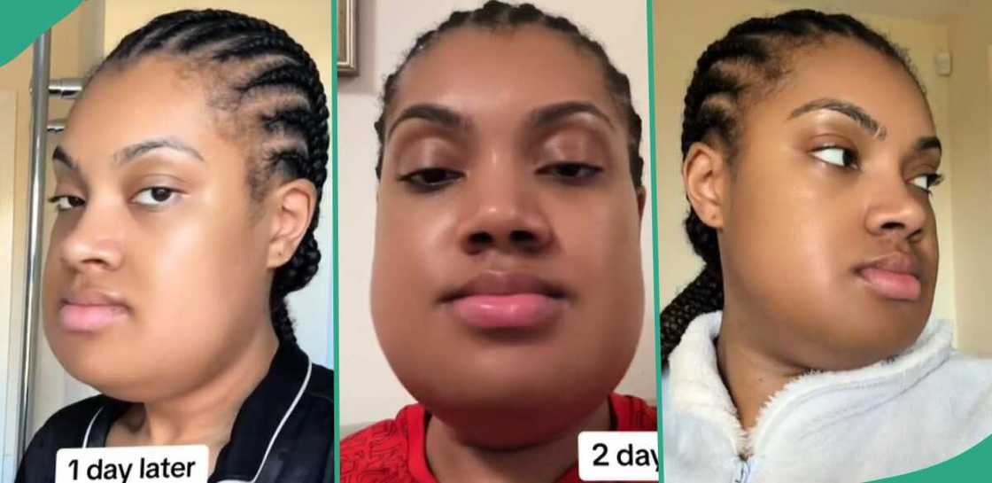 Lady shares recovery from her underbite jaw surgery. Lady shares recovery from her underbite jaw surgery.