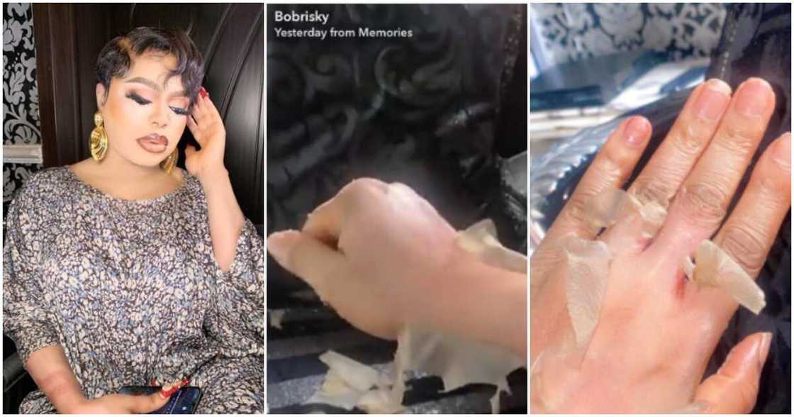 Bobrisky's skin peeling raises reactions. Bobrisky's skin peeling raises reactions.