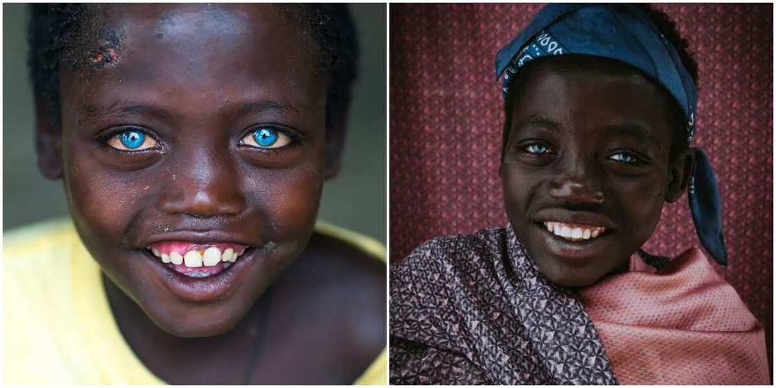 Boy with natural blue eyes said some people thought he was cursed