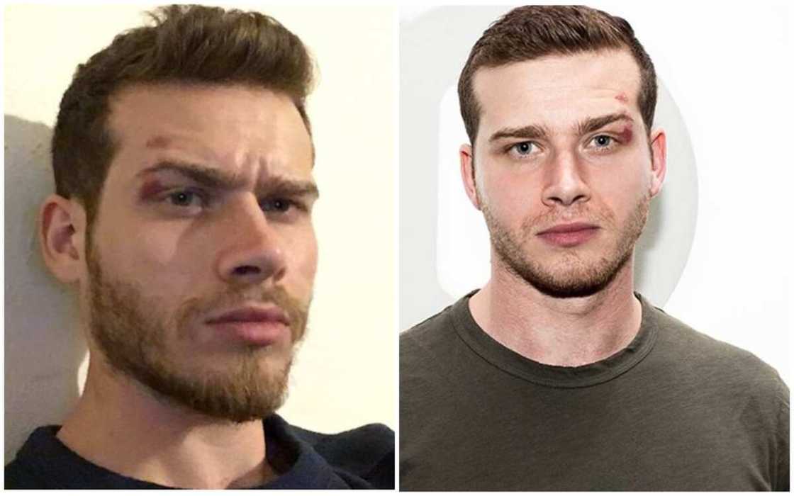 Oliver Stark birthmark Oliver Stark birthmark