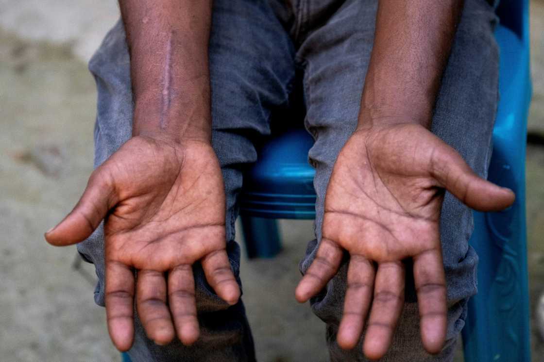 Shipbreaker Mizan Hossain, whose back was crushed in a 10-metre fall, showing his swollen hands Shipbreaker Mizan Hossain, whose back was crushed in a 10-metre fall, showing his swollen hands