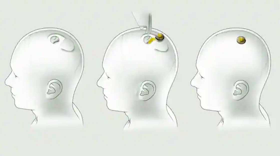 Elon Musk/ Neuralink/ brain implant