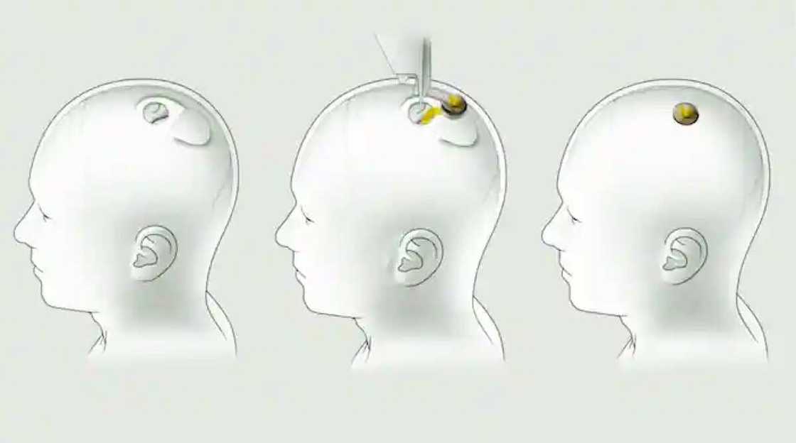 Elon Musk/ Neuralink/ brain implant Elon Musk/ Neuralink/ brain implant