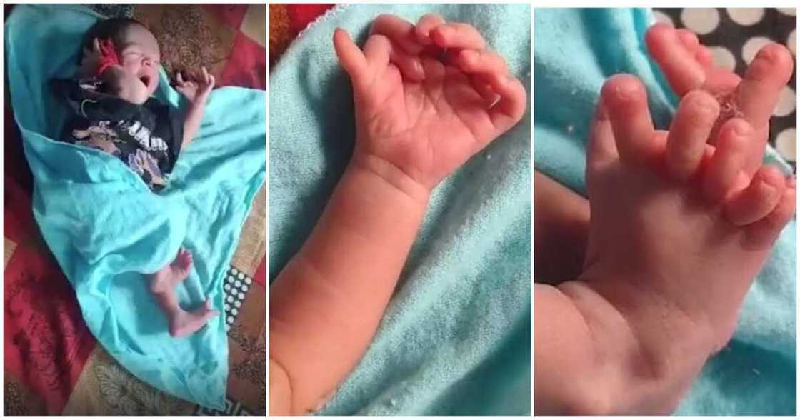 Baby born with 26 fingers and toes, India, Bharatpur Baby born with 26 fingers and toes, India, Bharatpur