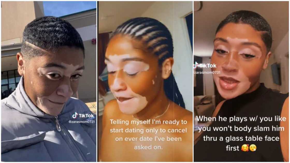 Vitiligo skin condition/lady showed her face. Vitiligo skin condition/lady showed her face.