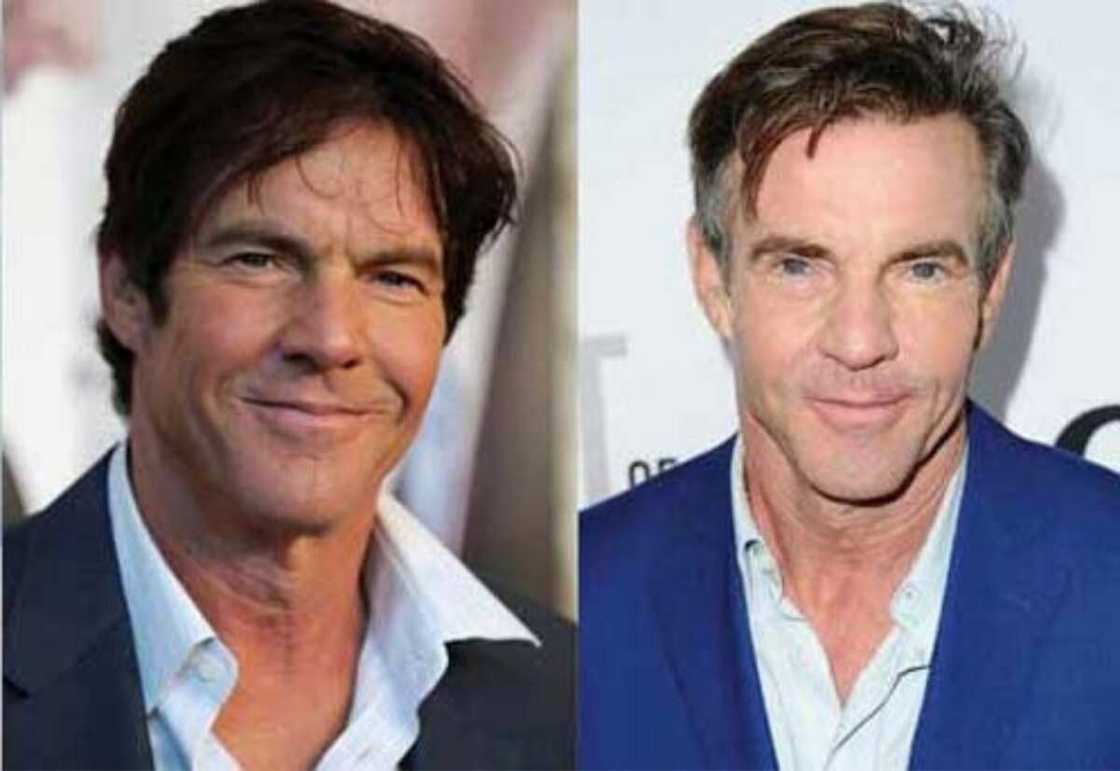 Dennis Quaid plastic surgery