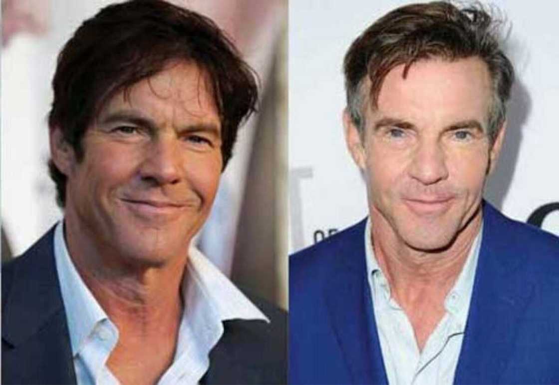 Dennis Quaid plastic surgery Dennis Quaid plastic surgery