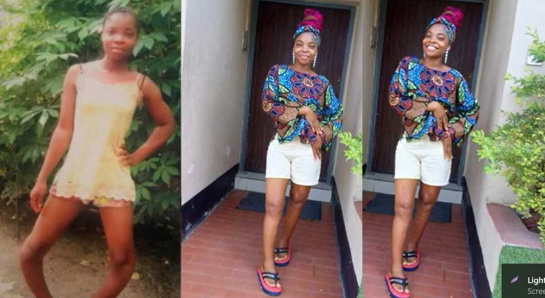 Photos of a lady with bowlegs after corrective surgery.