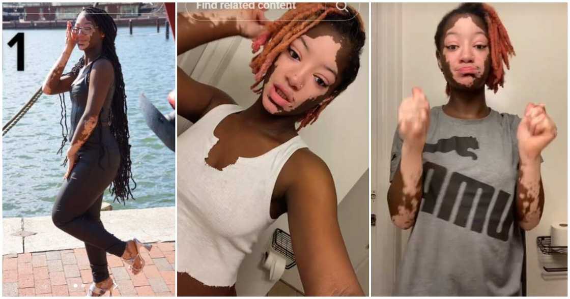 Young lady, skin colour, vitiligo Young lady, skin colour, vitiligo