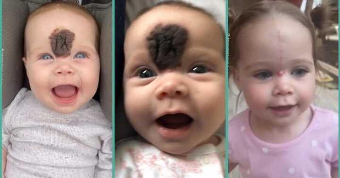 Little girl gets her thick birthmark removed Little girl gets her thick birthmark removed