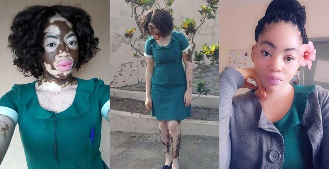Meet stunning Ghanaian nurse whose black skin has been taken over by vitiligo Meet stunning Ghanaian nurse whose black skin has been taken over by vitiligo