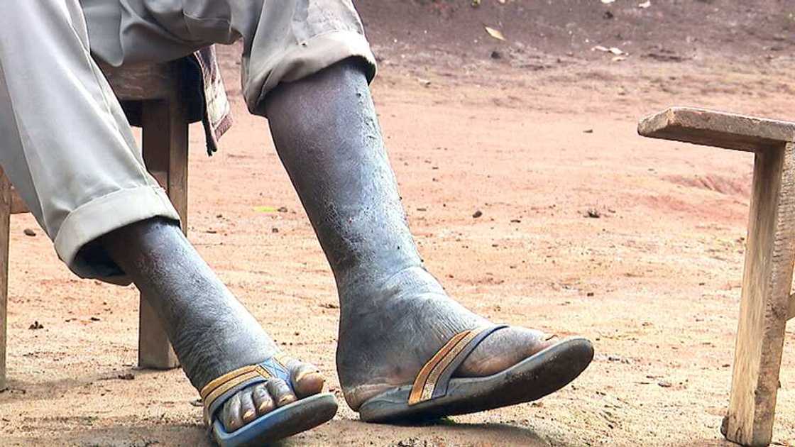 3 family members die in village devastated by elephantiasis 3 family members die in village devastated by elephantiasis