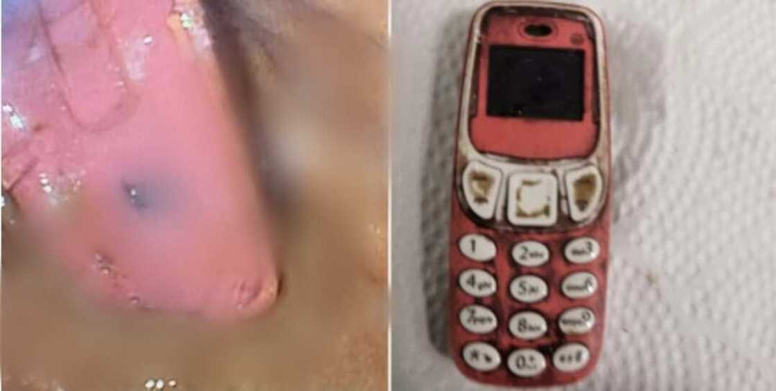 Likitoci sun fede wani mutum, sun ciro Nokia 3310 da ya hadiye