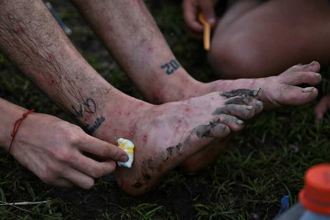 A man tends to his injuries at Canaan Membrillo village in Panama's Darien Jungle on October 12, 2022