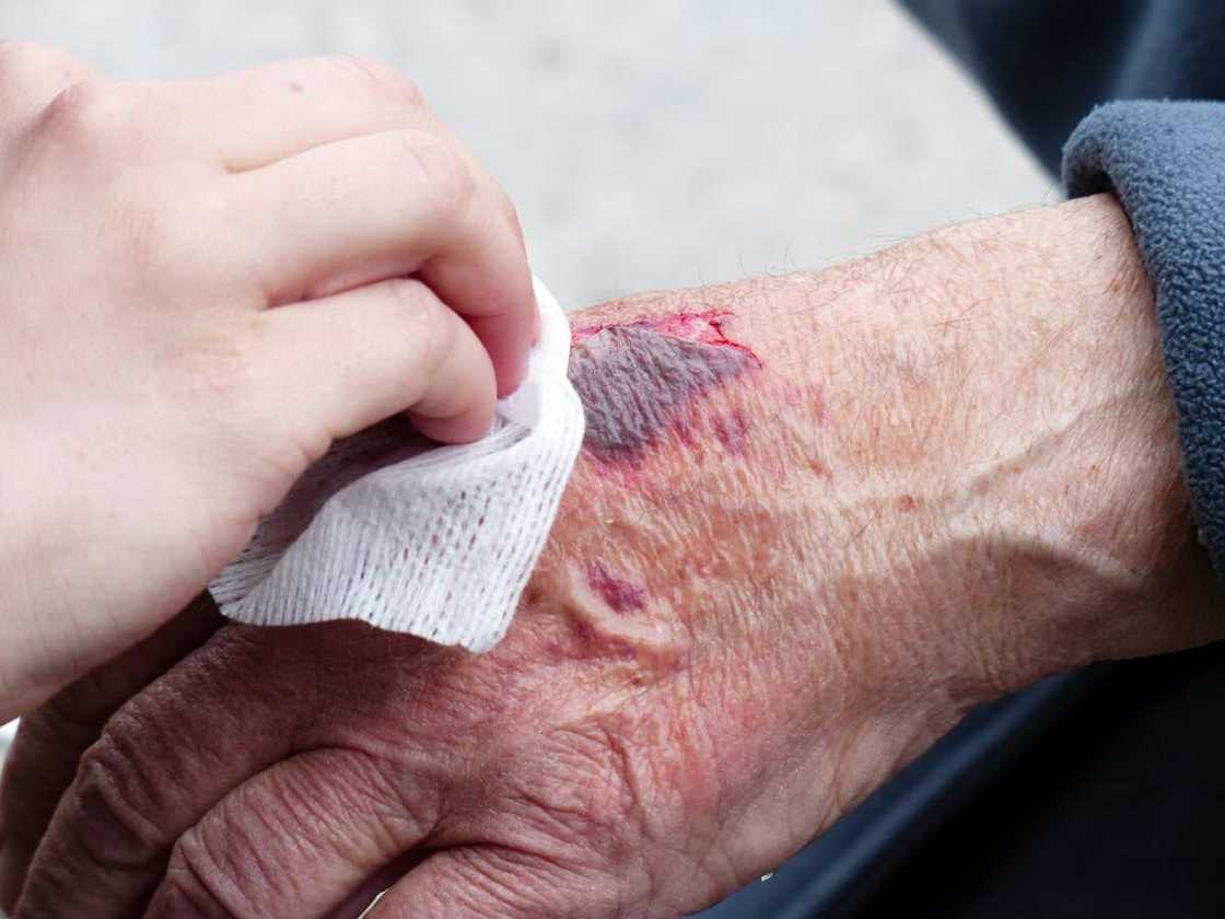 Removing adhesive from skin Removing adhesive from skin