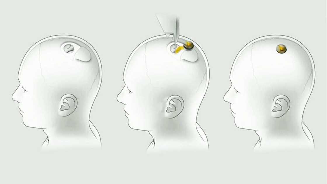 Elon Musk reveals microchips for Human Brains ready from 2022 control your phone without touching it Elon Musk reveals microchips for Human Brains ready from 2022 control your phone without touching it