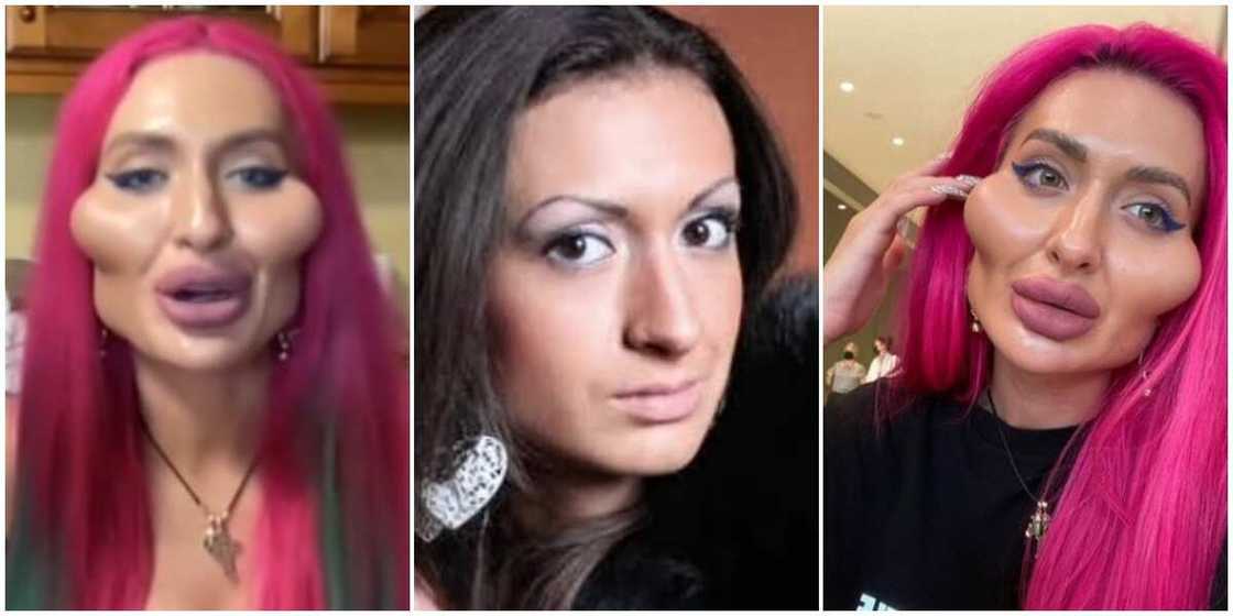 Budurwa ta kashe N904,000 don likitoci su kara mata girman labba da fuska Budurwa ta kashe N904,000 don likitoci su kara mata girman labba da fuska