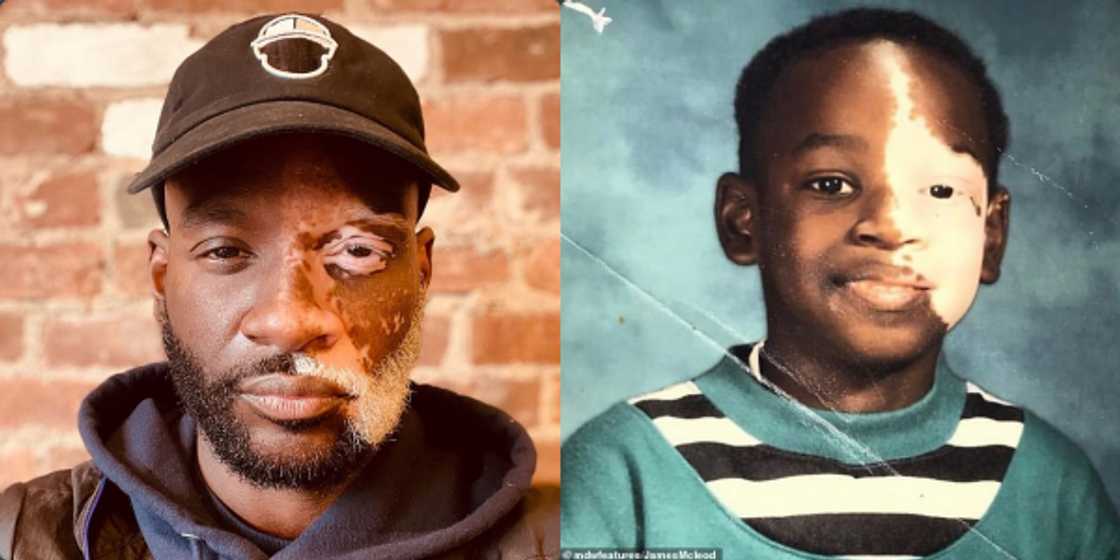 "It's Been My Greatest Blessing": Man with a Skin Disease Overcomes Child Bully To Become a Great Influencer "It's Been My Greatest Blessing": Man with a Skin Disease Overcomes Child Bully To Become a Great Influencer