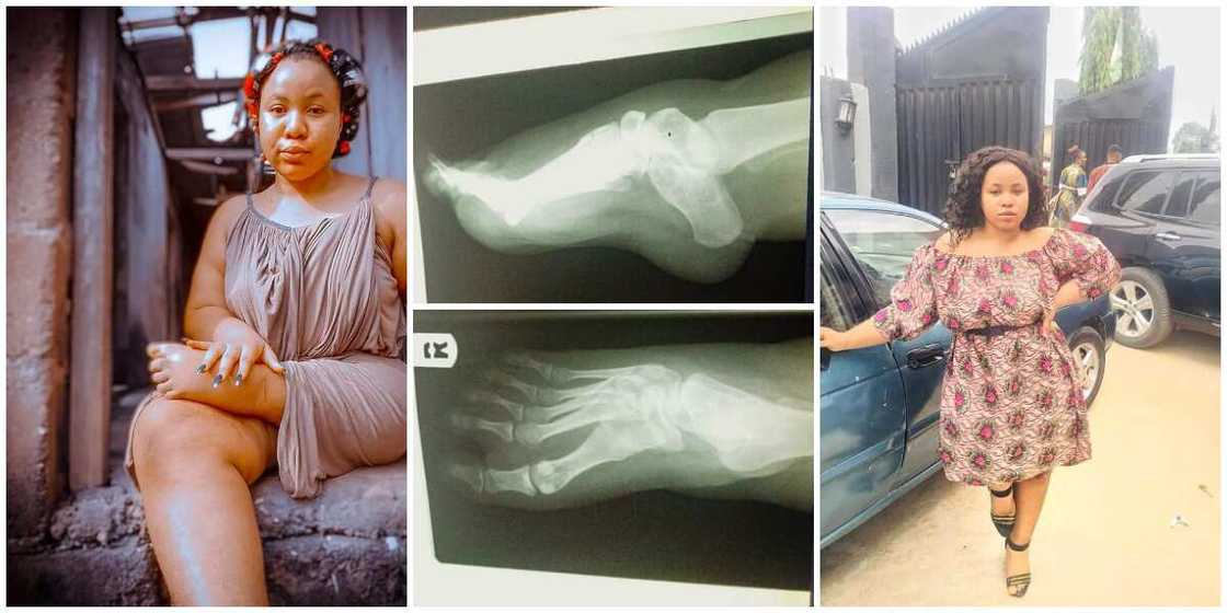 Lady Born with One and Half Leg Says she is Tired of Pains and Injuries, Begs Nigerians to Help Her Walk Again Lady Born with One and Half Leg Says she is Tired of Pains and Injuries, Begs Nigerians to Help Her Walk Again