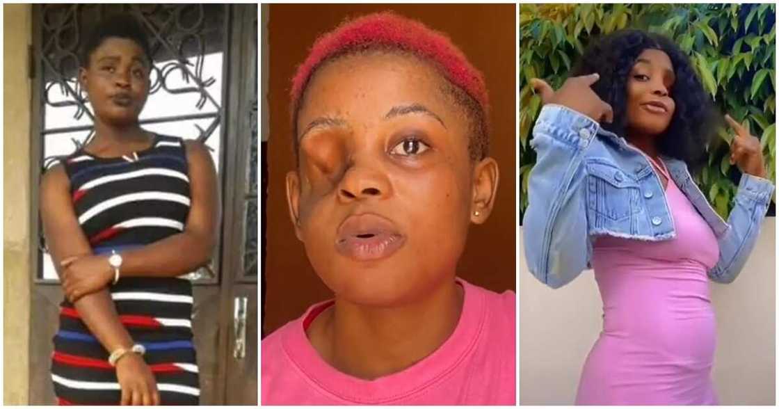 Cameroonian lady, Naronate Akum Ngwa who lost her eye after a gunshot. Cameroonian lady, Naronate Akum Ngwa who lost her eye after a gunshot.