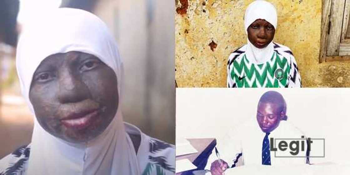 Bana iya numfashi: Ku taimakawa Rokibat a magance wata bakuwar cuta dake cin fuskarta Bana iya numfashi: Ku taimakawa Rokibat a magance wata bakuwar cuta dake cin fuskarta