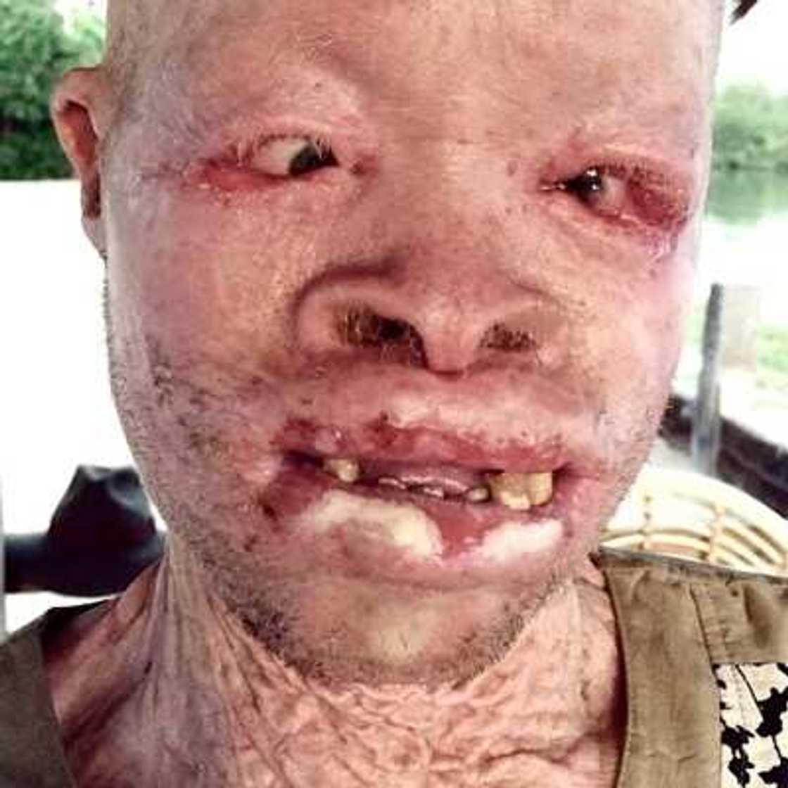 How Albinos are murdered in Africa How Albinos are murdered in Africa