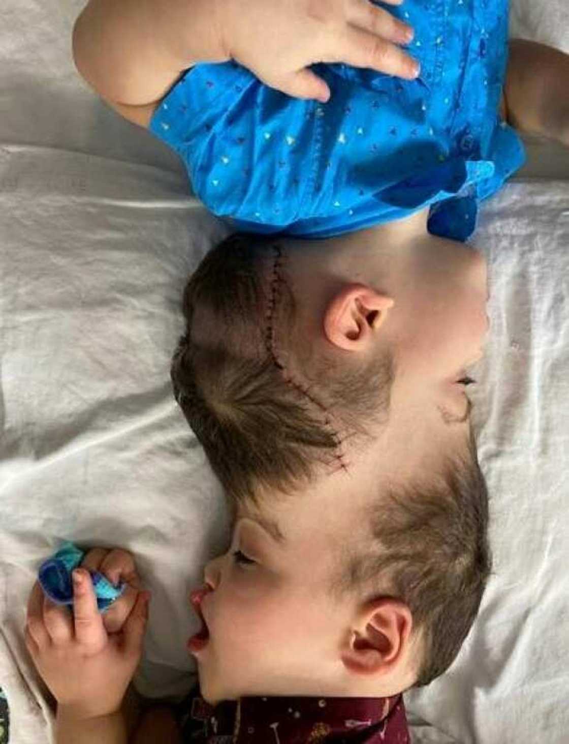 The conjoined twins were separated with help of virtual reality practise session in what experts described as the most complicated operation of its kind to date The conjoined twins were separated with help of virtual reality practise session in what experts described as the most complicated operation of its kind to date