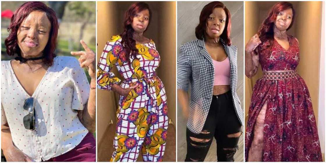 10 Times Plane Crash Survivor Kechi Okwuchi Gave Body Positivity Goals in Nice Photos 10 Times Plane Crash Survivor Kechi Okwuchi Gave Body Positivity Goals in Nice Photos
