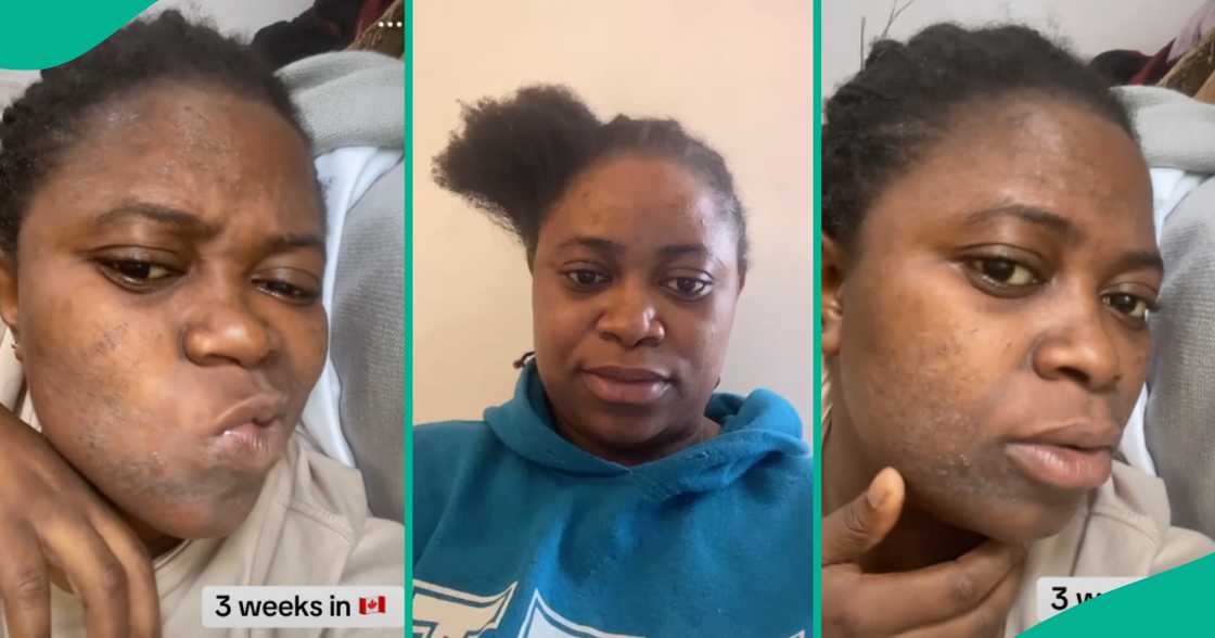 Nigerian lady who thought her skin would be clear in Canada shares what happened to her face in 3 weeks Nigerian lady who thought her skin would be clear in Canada shares what happened to her face in 3 weeks