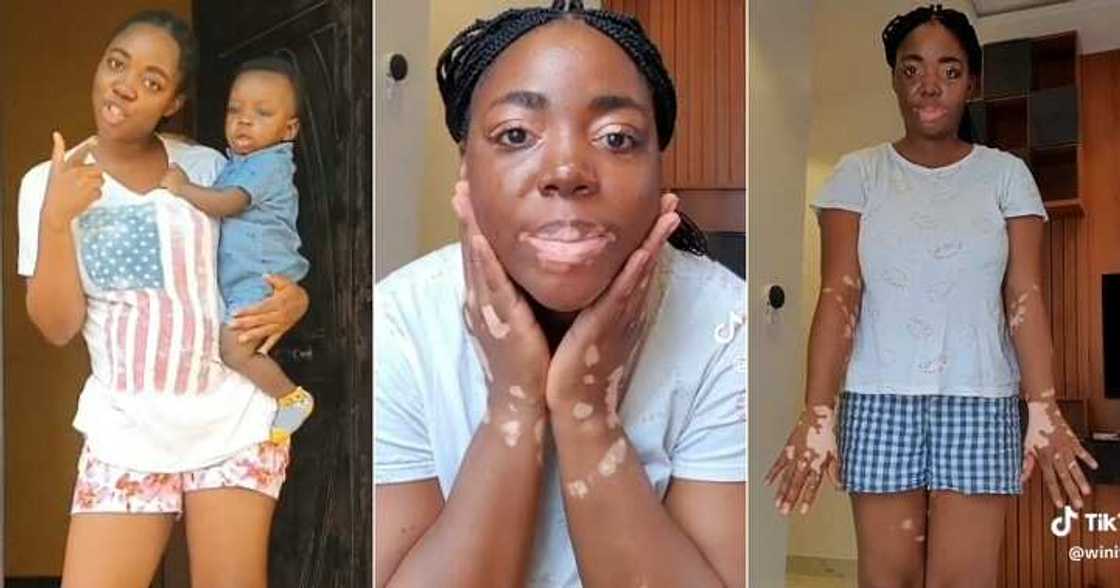 New mother develops vitiligo after birth New mother develops vitiligo after birth