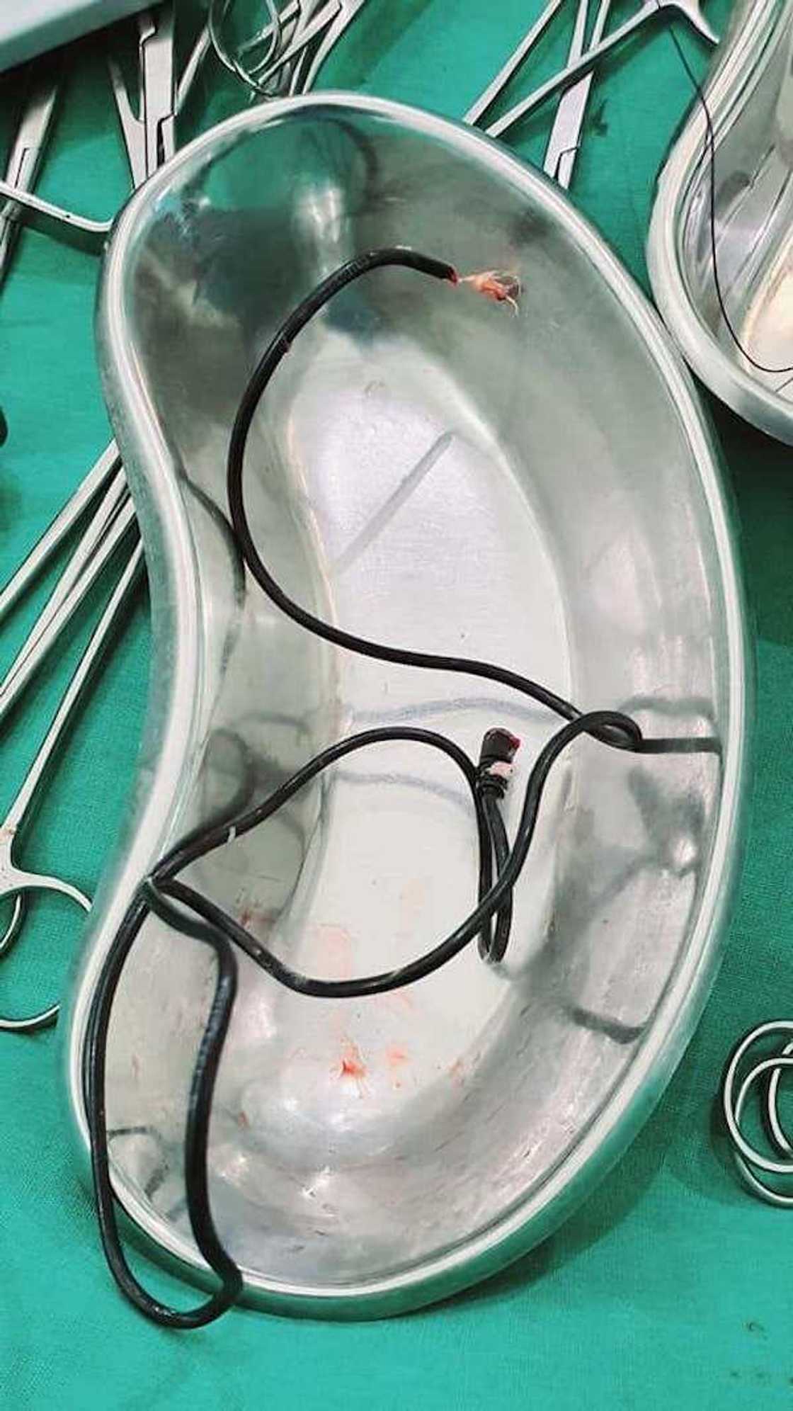 Allah mai iko: Likitoci sun cire cajar waya daga mafitsarar majinyaci Allah mai iko: Likitoci sun cire cajar waya daga mafitsarar majinyaci