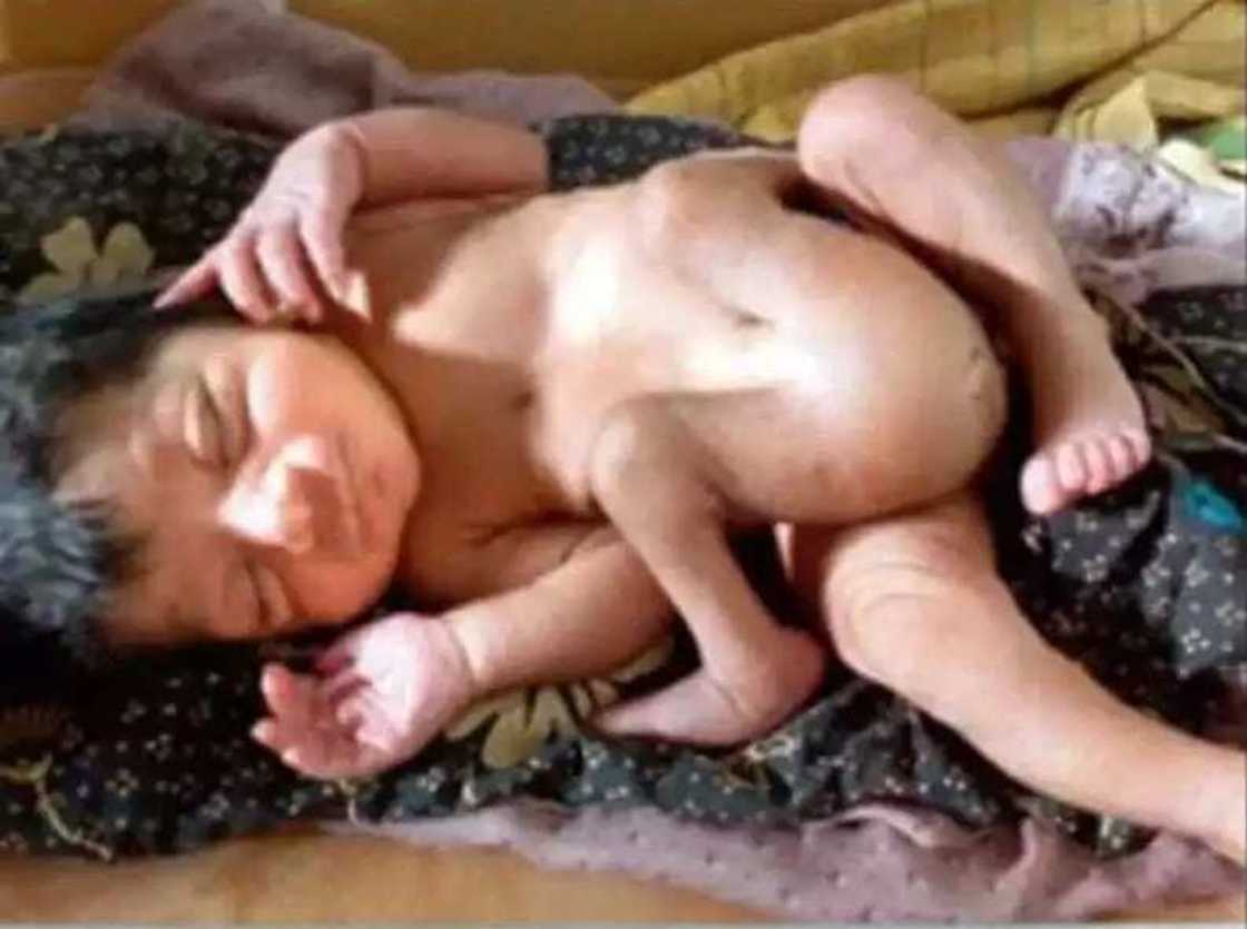 An haifi wani jariri a kasar Indiya mai kafa 4 mazakuta 2 (Hotuna) An haifi wani jariri a kasar Indiya mai kafa 4 mazakuta 2 (Hotuna)