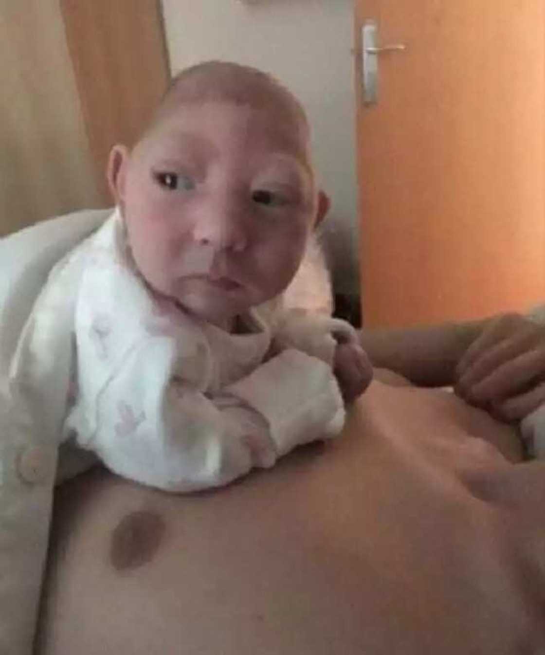 Jaririyar da aka haifa da kwakwalwarta a waje ta rayu Jaririyar da aka haifa da kwakwalwarta a waje ta rayu