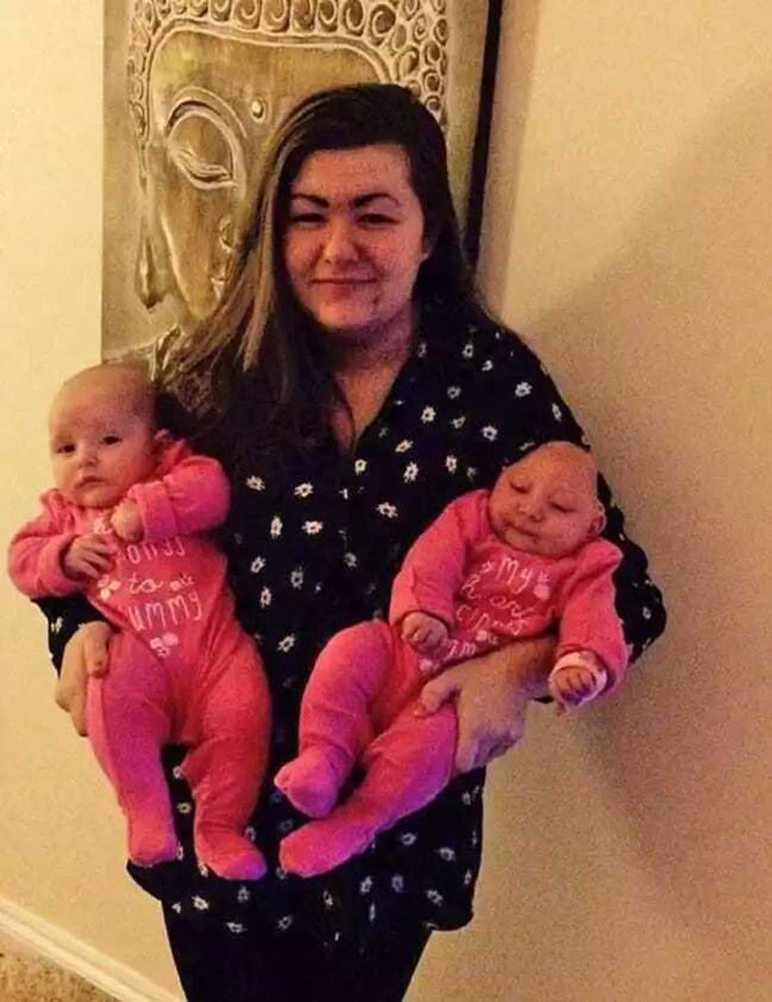 Jaririyar da aka haifa da kwakwalwarta a waje ta rayu Jaririyar da aka haifa da kwakwalwarta a waje ta rayu