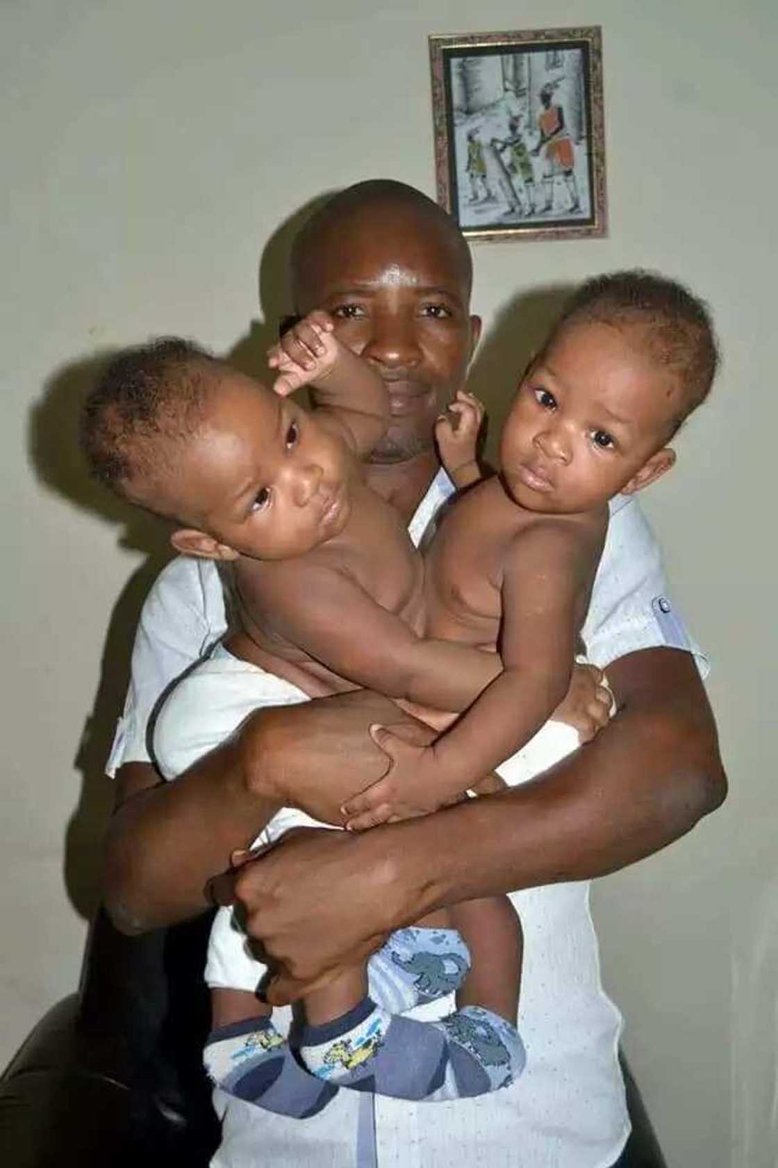 Nigerian conjoined twins separated by 22 doctors in India (photo) Nigerian conjoined twins separated by 22 doctors in India (photo)