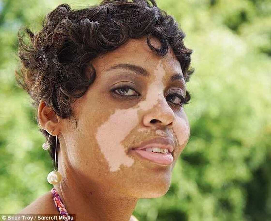 Black Woman With Vitiligo Tells Her Touching Story Black Woman With Vitiligo Tells Her Touching Story