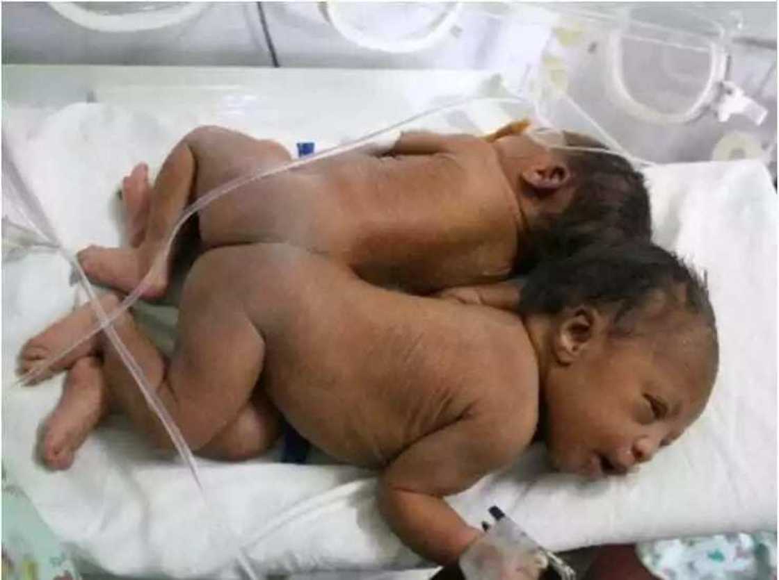 Abun mamaki, yan biyun da aka haifesu a kenya an raba su Abun mamaki, yan biyun da aka haifesu a kenya an raba su