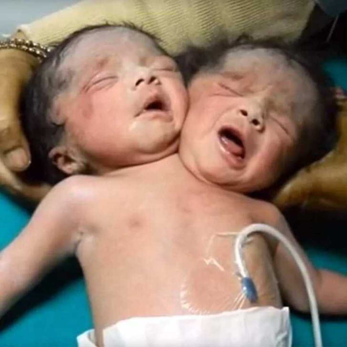 Jaririn da aka haifa mai kai biyu ya riga mu gidan gaskiya Jaririn da aka haifa mai kai biyu ya riga mu gidan gaskiya