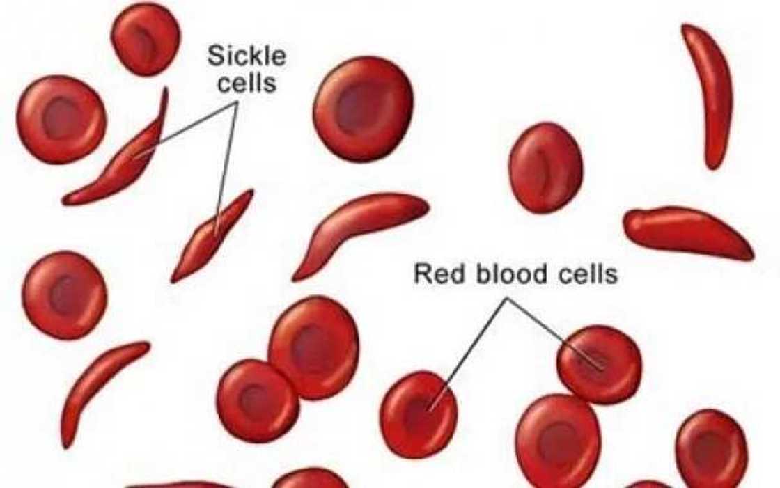 Anaemia Anaemia