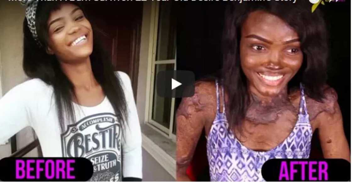 Burn survivor Burn survivor