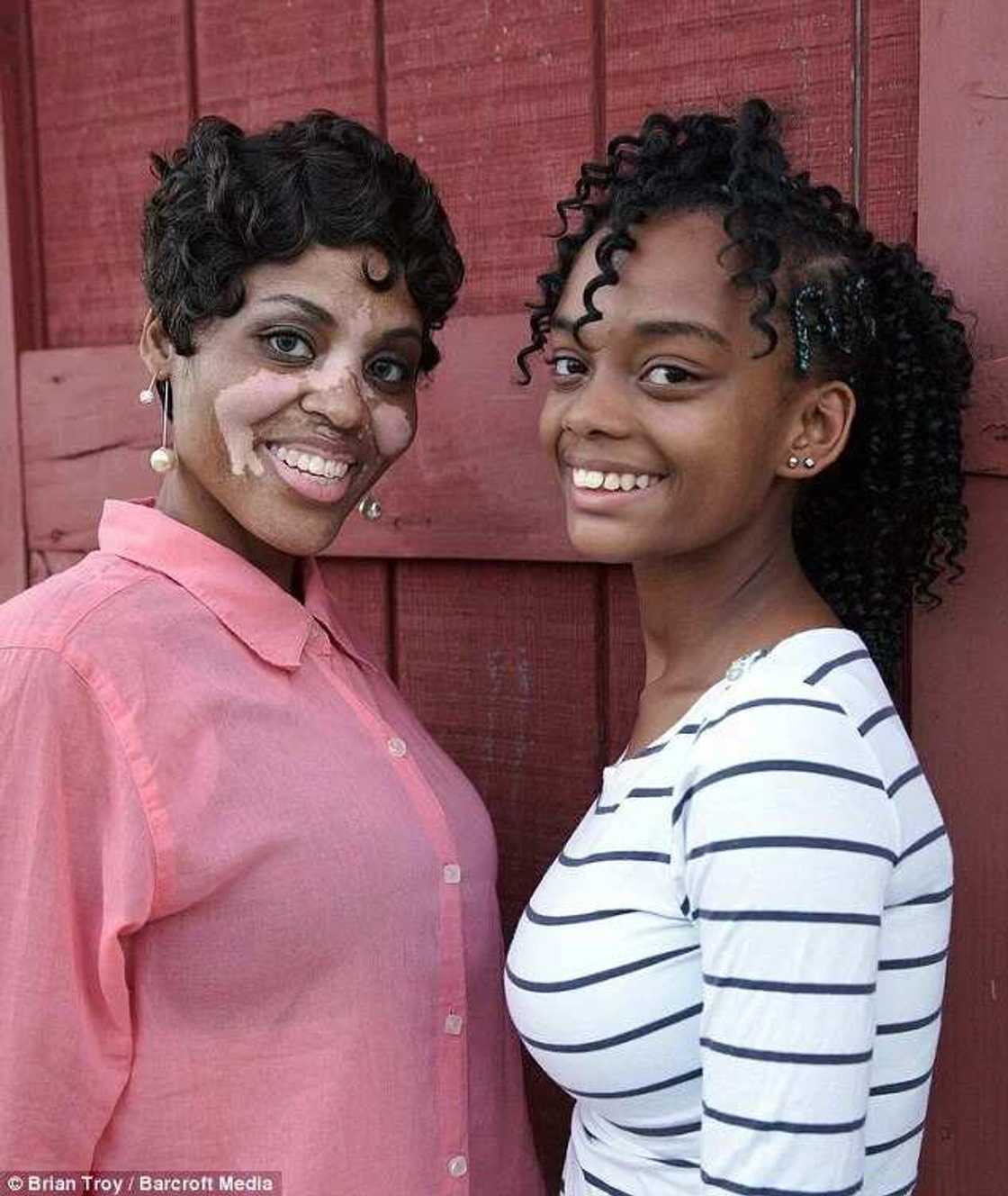 Black Woman With Vitiligo Tells Her Touching Story Black Woman With Vitiligo Tells Her Touching Story