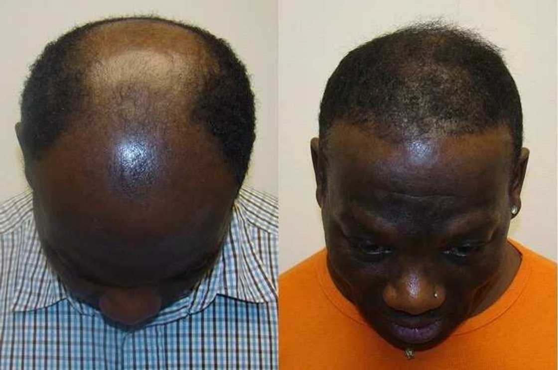 Abuja man reveals how he regrew his hair, cured baldness and severe hair loss within 14 days using a natural herbal remedy Abuja man reveals how he regrew his hair, cured baldness and severe hair loss within 14 days using a natural herbal remedy