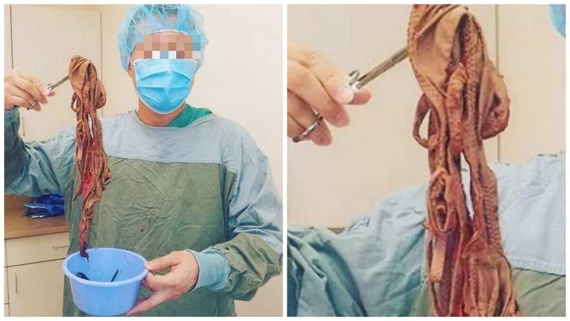 Likita ya fitar da wani abun mamaki a cikin tumbin wani (Hotuna) Likita ya fitar da wani abun mamaki a cikin tumbin wani (Hotuna)